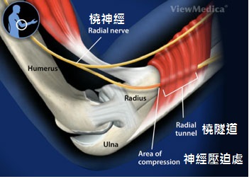 radial-tunnel-syndrome-cause-cn